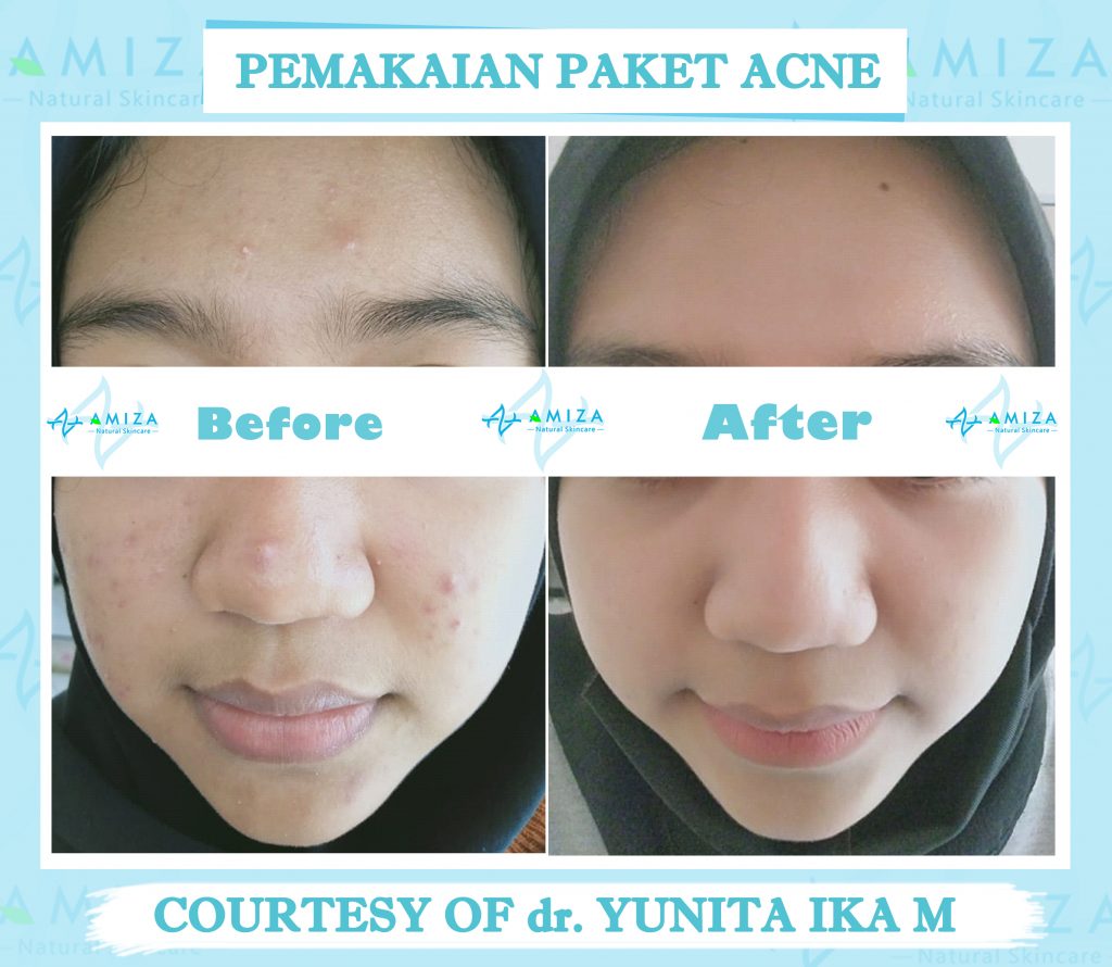 skin care semarang, jual skin care semarang, jual skincare di semarang, skincare di semarang, jual skincare murah semarang, skincare murah aman semarang, skincare terpercaya dan aman, skincare bpom dan halal, skincare halal semarang, skincare halal dan aman, skincare tanpa efek samping, jual skincare glowing, merk skincare yang aman untuk kulit, jual skincare Kendal, produk skincare Kendal, harga skincare amiza, harga paket skincare amiza, paket skincare terlengkap, paket skincare terbaik, Paket Skincare terbaik BPOM, paket skincare glowing, paket skincare untuk kulit glowing, skincare murah kaliwungu, skincare kaliwungu, produk lokal skincare terbaik, brand skincare semarang, brand skincare terbaik Indonesia, brand skincare terbaik halal, merk skincare terbaik Indonesia, daftar harga paket skincare, paket skincare murah, paket skincare murah dan aman, paket skincare murah semarang, paket skincare acne murah, rekomendasi skincare lokal, rekomendasi skincare semarang, rekomendasi skincare murah dan aman, rekomendasi skincare aman dan halal, daftar paket skincare murah, skincare murah berkualitas, Merk skincare lokal terbaik, skincare semarang murah, produk skincare murah dan aman, produk skincare teruji bpom, produk skincare bersertifikat bpom, skincare bersertifikat bpom, daftar skincare bpom untuk glowing, skincare lokal bpom, paket skincare murah terbaik, skincare murah aman berkualitas