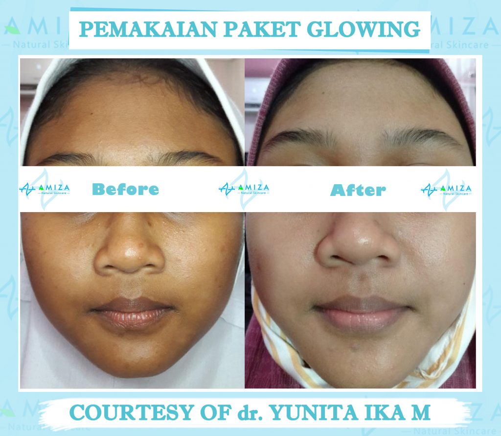 skin care semarang, jual skin care semarang, jual skincare di semarang, skincare di semarang, jual skincare murah semarang, skincare murah aman semarang, skincare terpercaya dan aman, skincare bpom dan halal, skincare halal semarang, skincare halal dan aman, skincare tanpa efek samping, jual skincare glowing, merk skincare yang aman untuk kulit, jual skincare Kendal, produk skincare Kendal, harga skincare amiza, harga paket skincare amiza, paket skincare terlengkap, paket skincare terbaik, Paket Skincare terbaik BPOM, paket skincare glowing, paket skincare untuk kulit glowing, skincare murah kaliwungu, skincare kaliwungu, produk lokal skincare terbaik, brand skincare semarang, brand skincare terbaik Indonesia, brand skincare terbaik halal, merk skincare terbaik Indonesia, daftar harga paket skincare, paket skincare murah, paket skincare murah dan aman, paket skincare murah semarang, paket skincare acne murah, rekomendasi skincare lokal, rekomendasi skincare semarang, rekomendasi skincare murah dan aman, rekomendasi skincare aman dan halal, daftar paket skincare murah, skincare murah berkualitas, Merk skincare lokal terbaik, skincare semarang murah, produk skincare murah dan aman, produk skincare teruji bpom, produk skincare bersertifikat bpom, skincare bersertifikat bpom, daftar skincare bpom untuk glowing, skincare lokal bpom, paket skincare murah terbaik, skincare murah aman berkualitas
